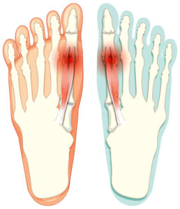Halluks Valgus Nedir
