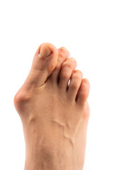 Halluks valgus nedir