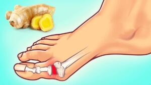 Gut Hastalığı Nedir?