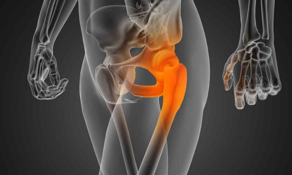 Hip Joint Fracture