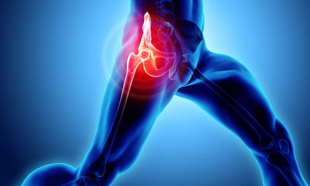 Hip Joint Fracture