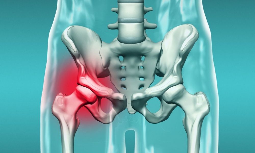 Hip Joint Fracture