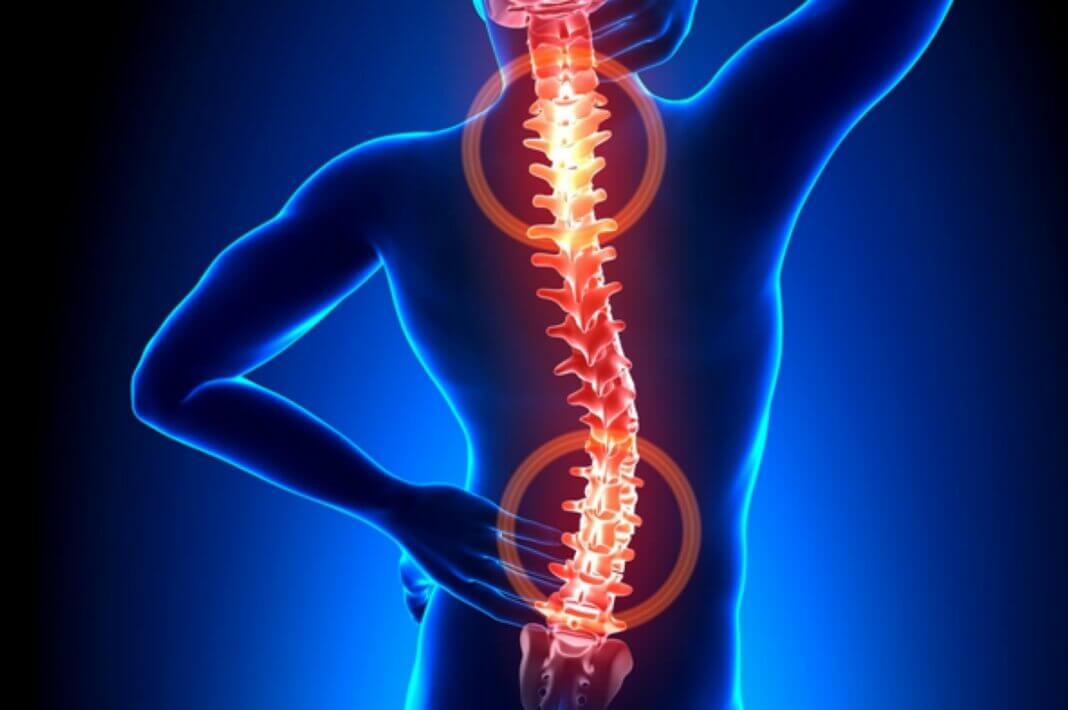 Boyun Fıtığı Nedir? 