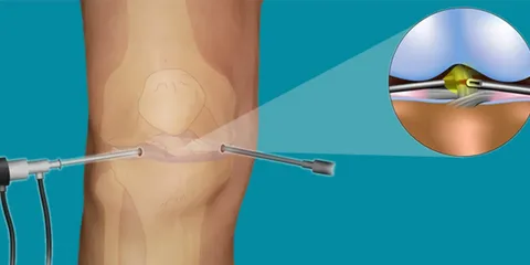 Artroskopi Menisküs Ameliyatı