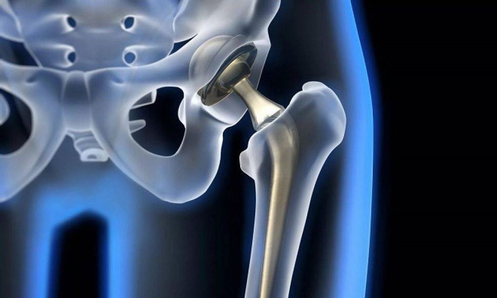 Robotik Kalça Protezi Nedir?