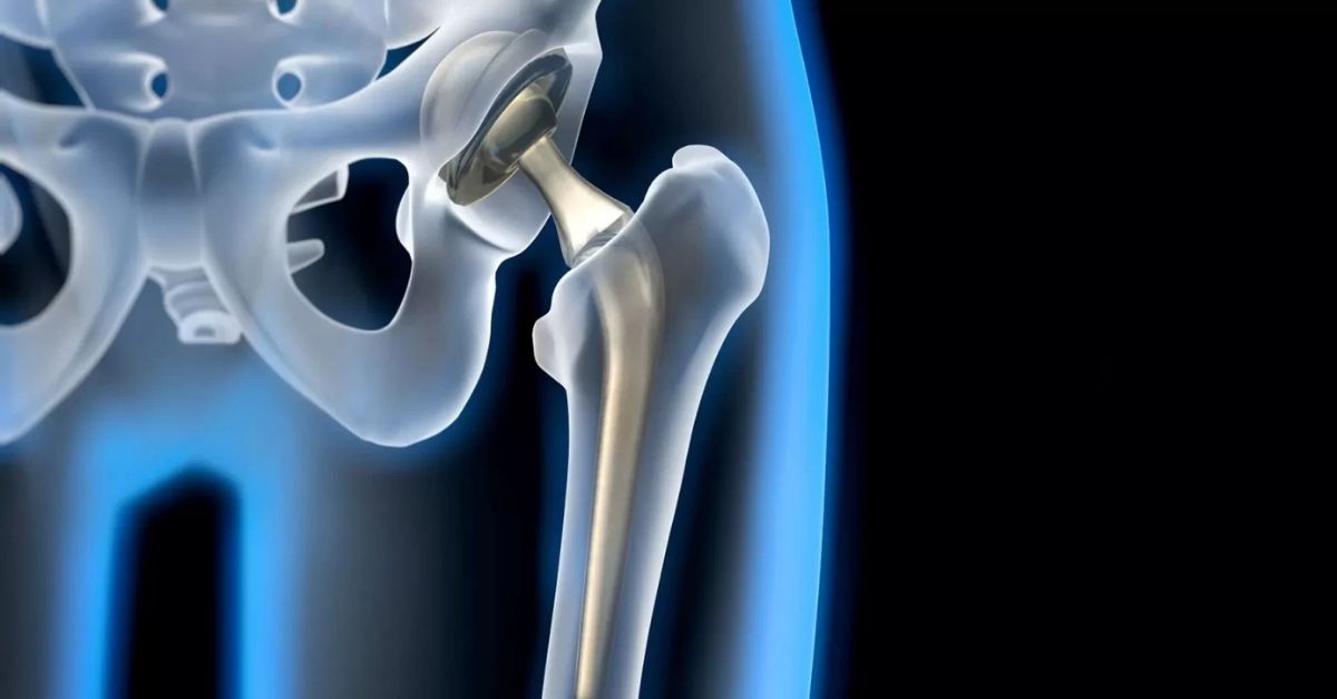 Robotik Kalça Protezi Ameliyatı Fiyatı